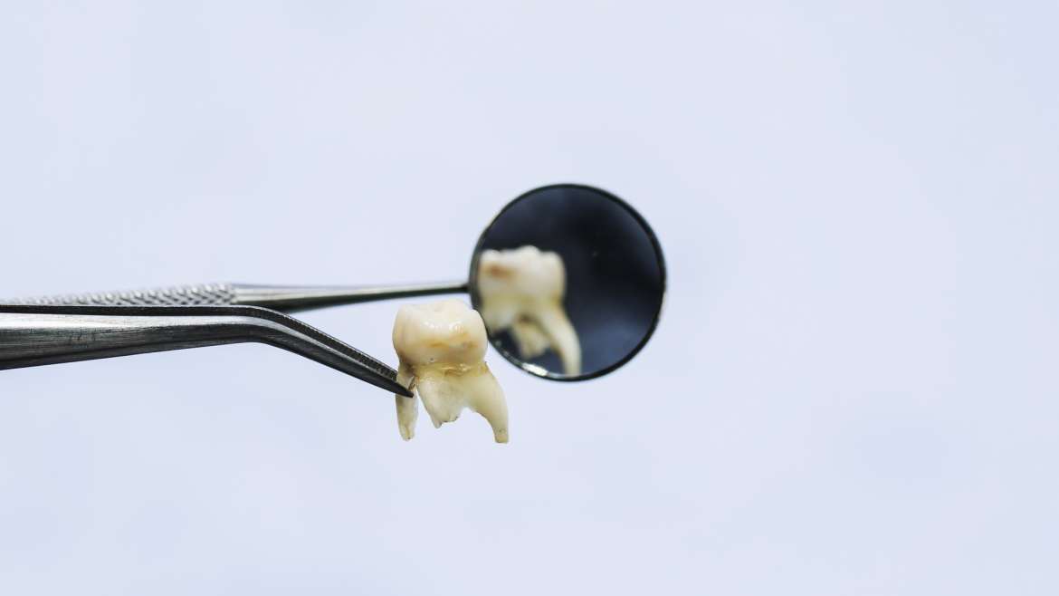 There’s A Lot You Can Do  To Prevent Tooth Loss