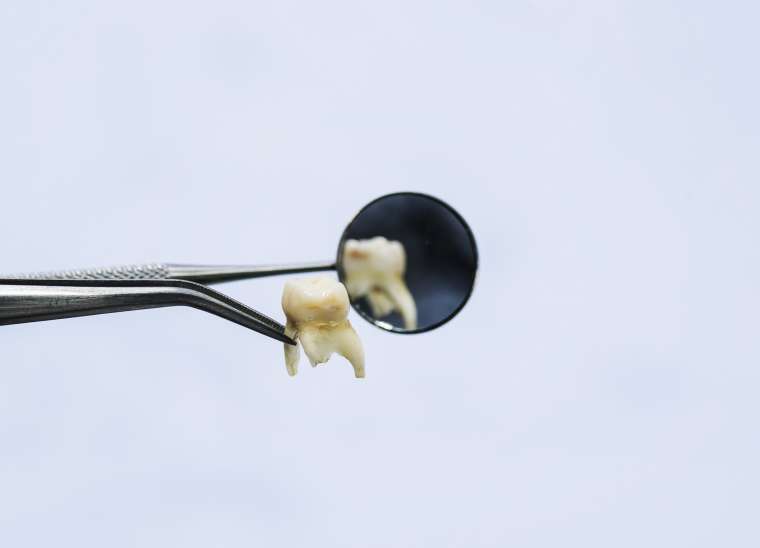 There’s A Lot You Can Do  To Prevent Tooth Loss